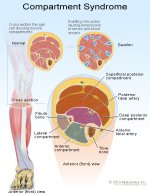 compartment-syndrome2.jpg