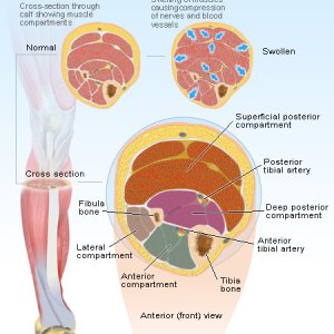 compartment-syndrome2.jpg